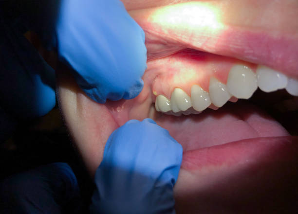 Best Emergency Dentist for Lost Fillings or Crowns in Mcchord Af, WA